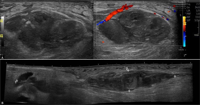 Hematoma ecografia tempo formacion 7.jpg